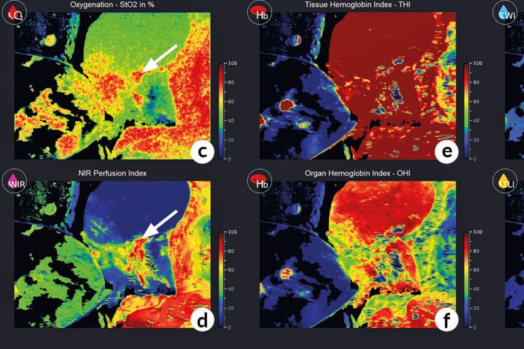 Hyperspektral-Imaging zeigt Gewebeperfusion, Sauerstoffsättigung und Hämoglobinindex im OP